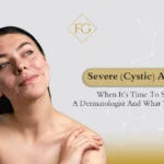 cystic acne treatment options